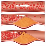 Cholesterol-1024x1024